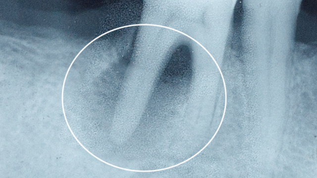 Röntgenbild: Abgestorbener Zahn mit Entzündung im Kieferknochen