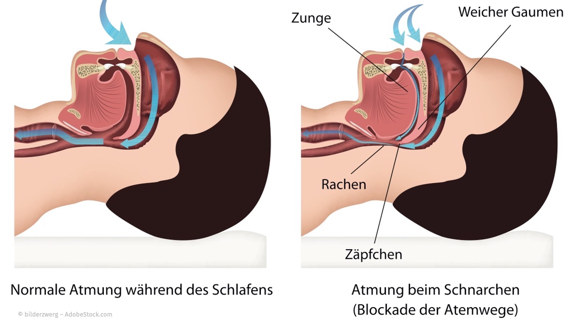 Die Ursache für das Schnarchen