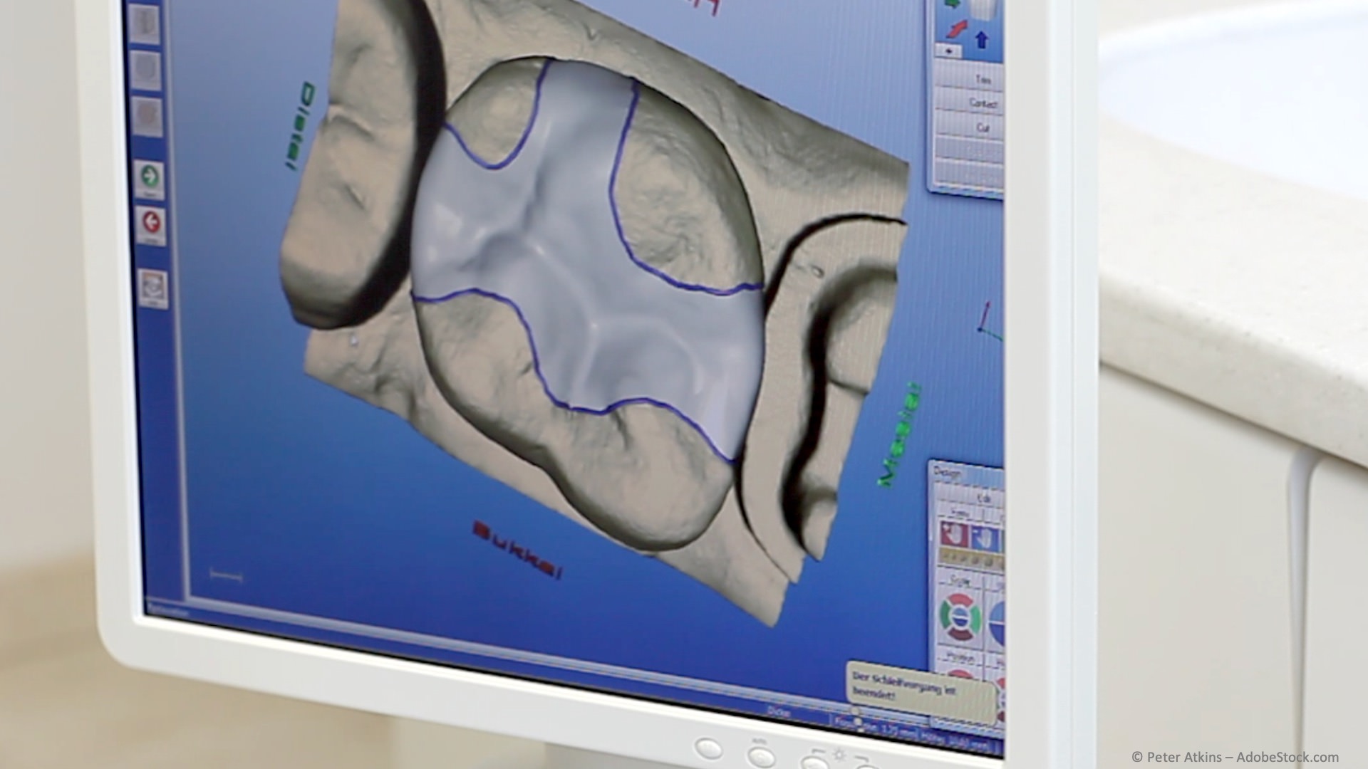 CEREC: Inlays + Zahnersatz aus Keramik